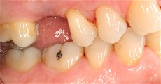 Patient had a missing upper molar replaced with a single tooth implant.
